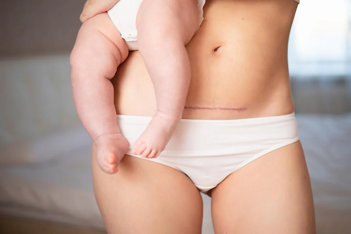 Brzuch mamy po cięciu cesarskim, szew blizny, młoda matka trzyma dziecko