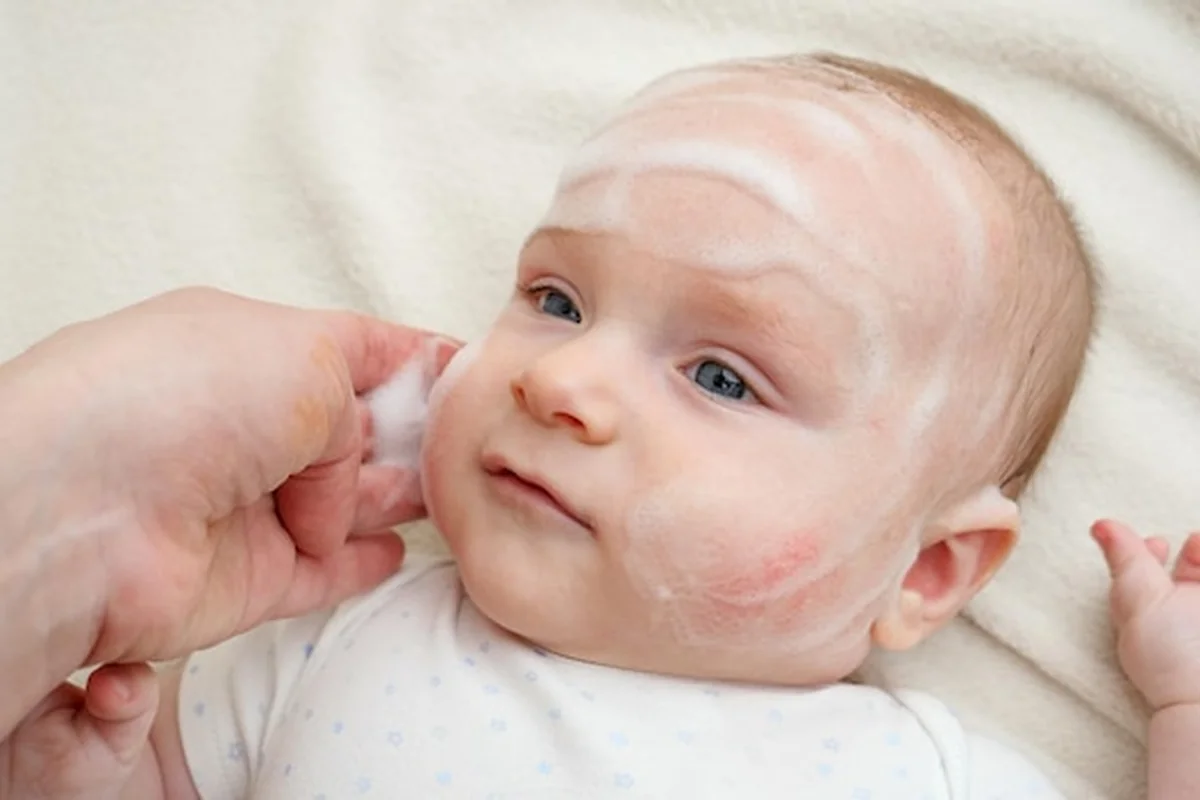 Małe dziecko z zapaleniem skóry leczone kremem i maścią