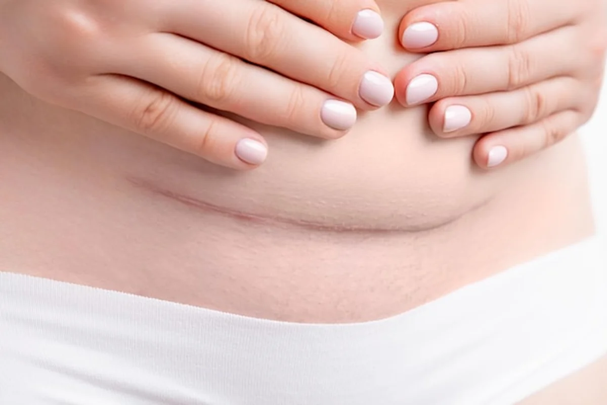 Brzuch kobiety z dużą blizną po cesarskim cięciu